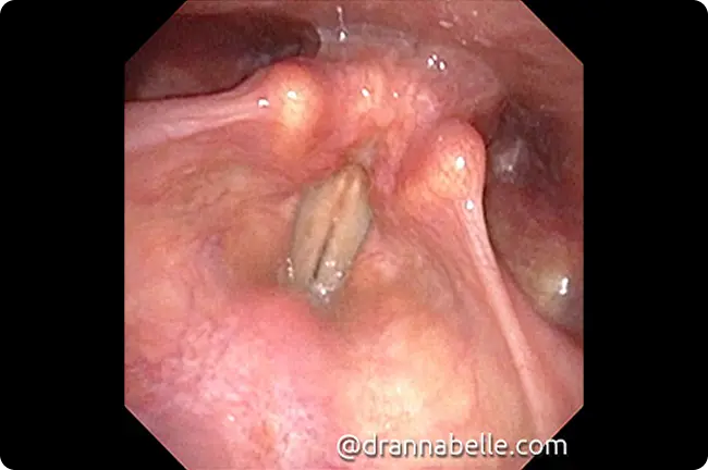 Vocal cords at rest forming a V shape