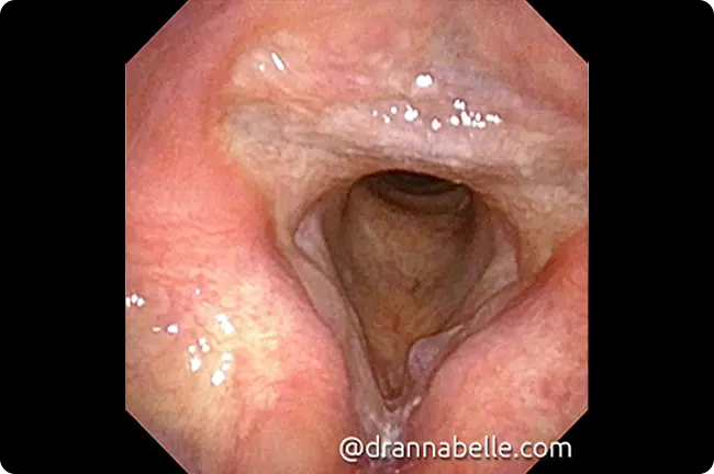 Polyp on the left vocal cord