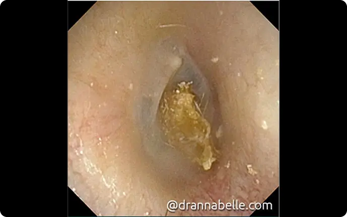 Wax stuck onto the right eardrum from cotton buds