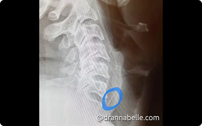 X-ray showing a fishbone lodged deep in the throat